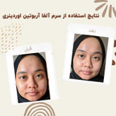 سرم آلفا آربوتین 2% + HA اوردینری ضد لک