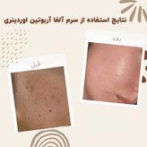 سرم آلفا آربوتین 2% + HA اوردینری ضد لک
