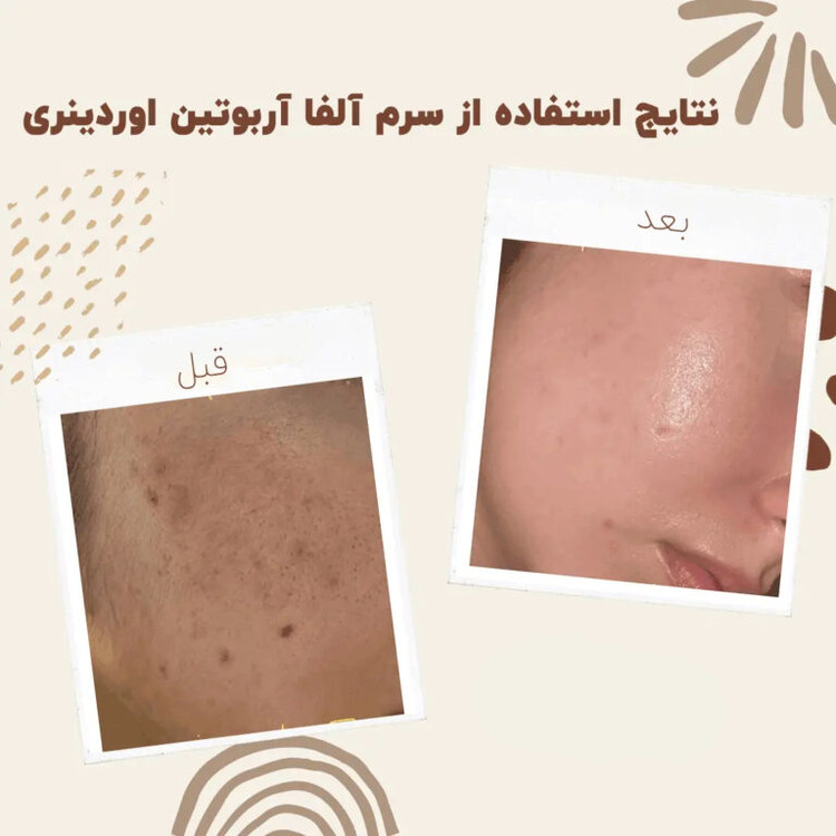 سرم آلفا آربوتین 2% + HA اوردینری ضد لک