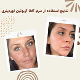 سرم آلفا آربوتین 2% + HA اوردینری ضد لک