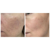 سرم التیام بخش سنتلا ماداگاسکار اسکین 1004 SKIN1004 Madagascar Centella Ampoule