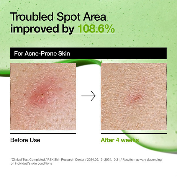 سرم آزلائیک اسید 10% و هیالورون آنوا Anua Azelaic Acid 10+ Hyaluron Soothing Serum 30Ml